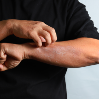What Can Make Eczema Worse? Exploring Common Risk Factors